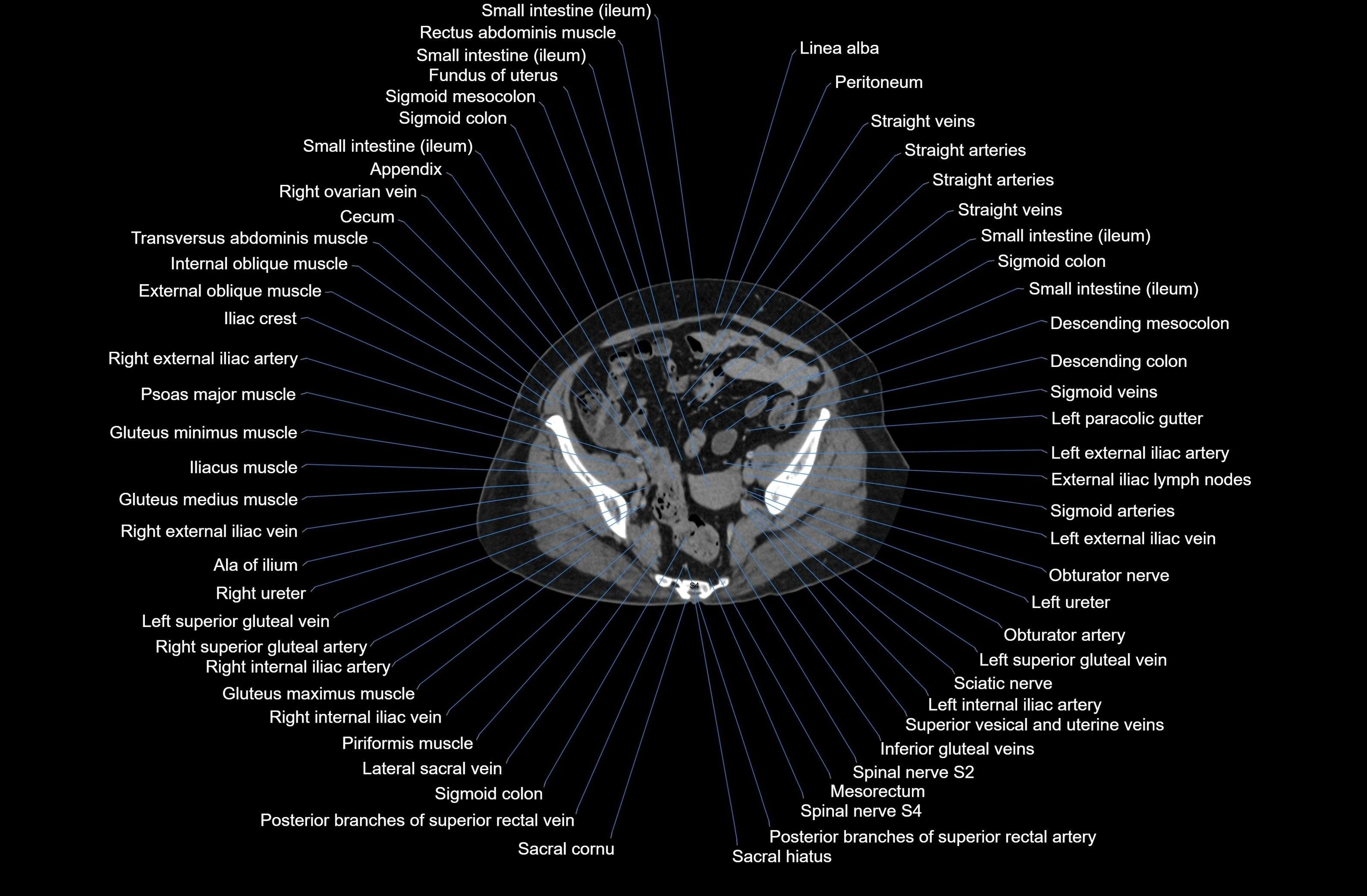 CT Abdomen axial cross sectional anatomy labelled radiology image-00077.webp